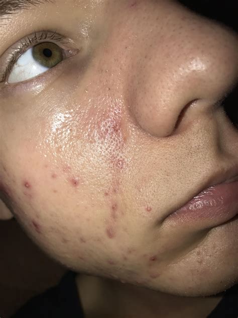 very oily skin reddit|very oily skin treatment.